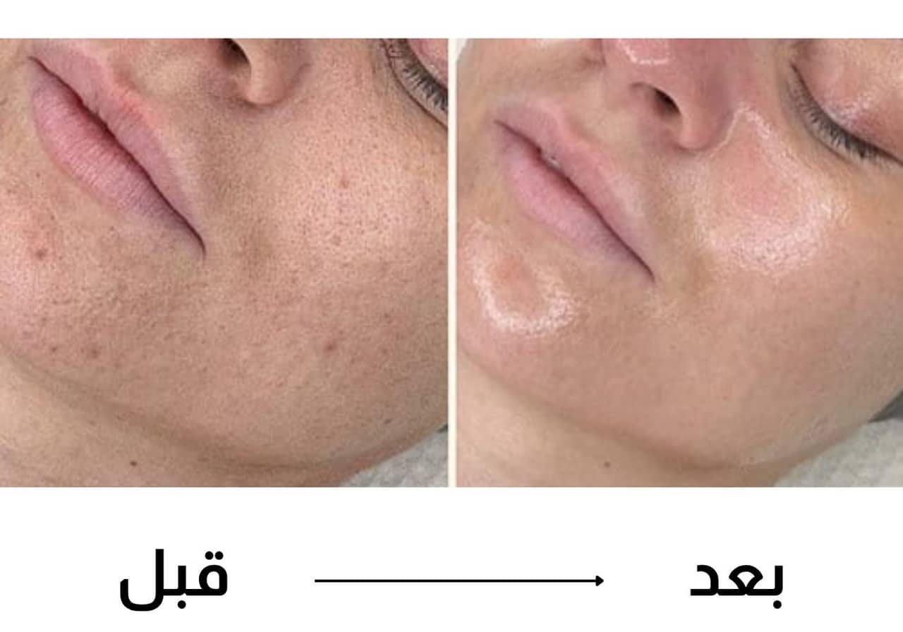 مجموعة العناية - جهاز إزالة الرؤوس السوداء - جهاز إزالة الشعر - 2 في 1 — صورة 9